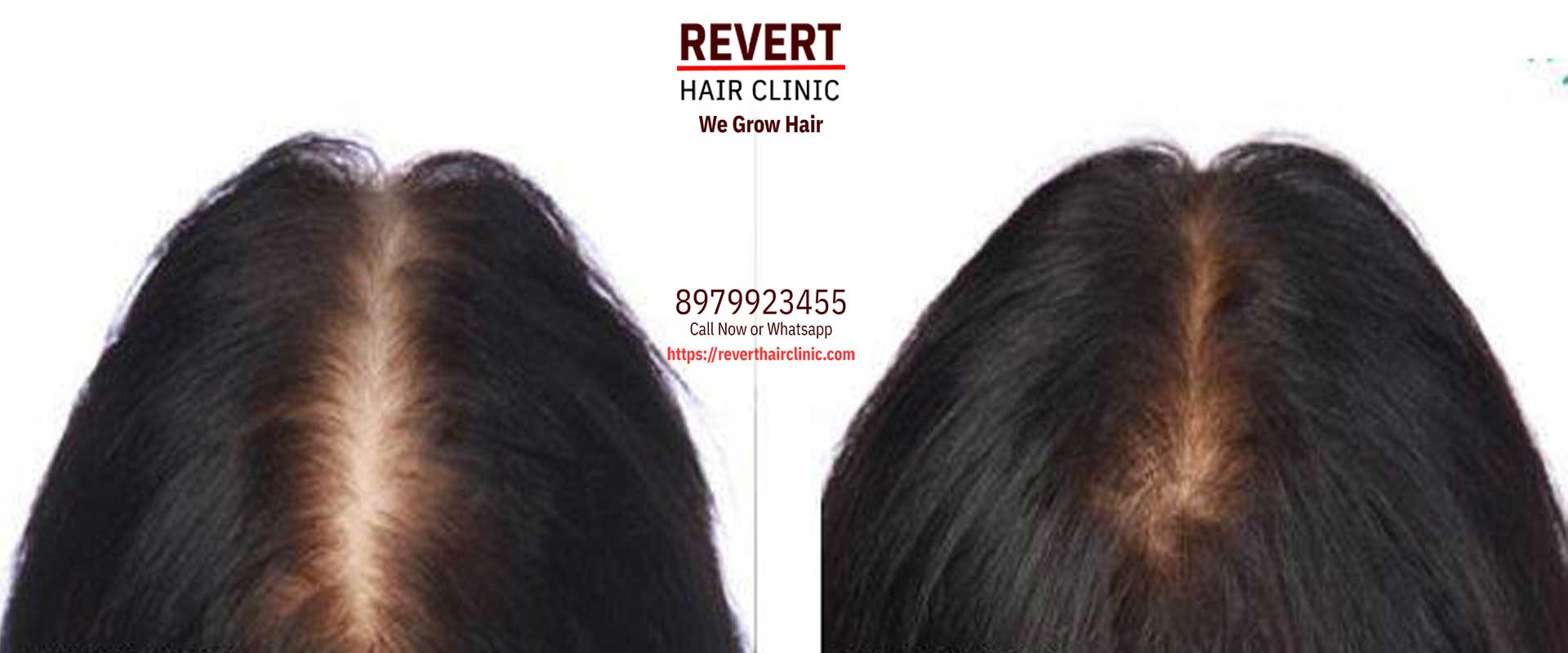 Revert Hair Clinic | Best hair Clinic | Hair Specialist Surgeon Dehradun